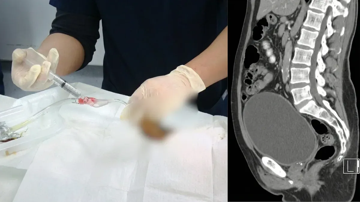 I tre år tog jeg alle de prostata-piller, min læge ordinerede — indtil jeg klokken 3 om natten endte på skadestuen med en slange indsat i min penis